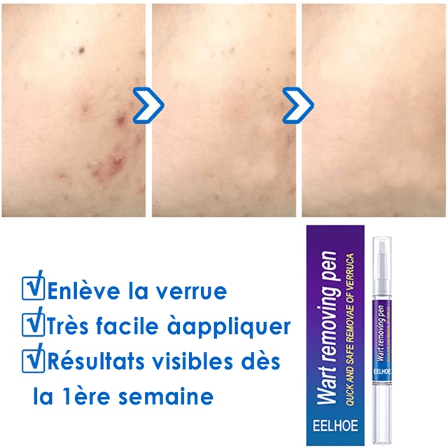 Gadgets d'Eve TAGFREE™ : Stylo Anti-Verrue